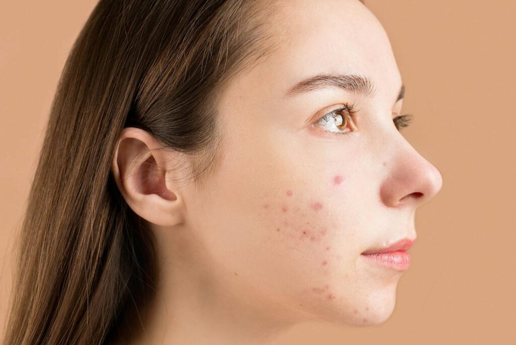 Close-Up-Photo-of-a-Teenager-with-Pimples-on-Her-Face