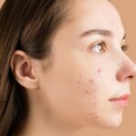 Close-Up-Photo-of-a-Teenager-with-Pimples-on-Her-Face