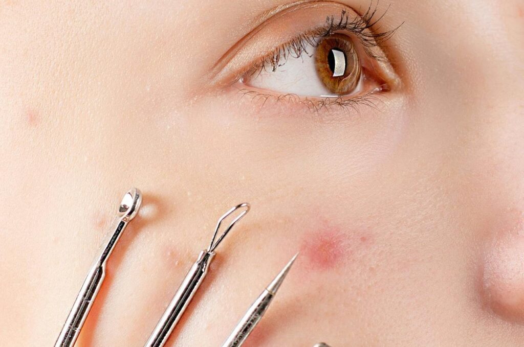 Womans-Face-With-Four-Skin-Extractor-Tools